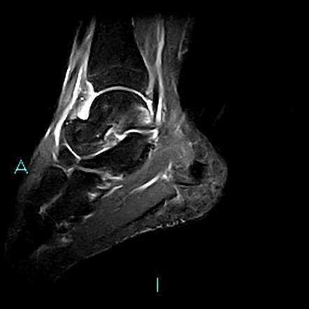 Posterior Ankle Impingement Radiology Case Radiopaedia Org