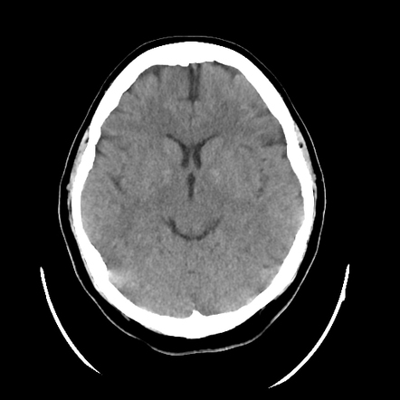 Normal Ct Head And Cervical Spine Radiology Case Radiopaedia Org