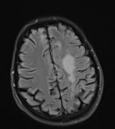 Hidden Diagnosis Case Radiology Case Radiopaedia Org