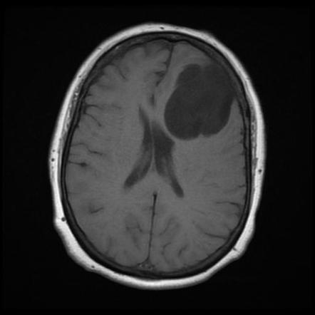 Large Arachnoid Cyst Image Radiopaedia Org