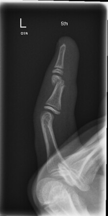 Middle Phalanx Fracture Radiology Case Radiopaedia Org