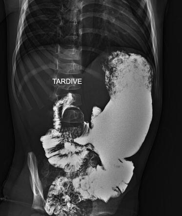 Duodenal Duplication Cyst Radiology Case Radiopaedia Org