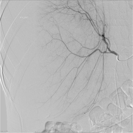 Subcapsular Liver Hematoma With Embolization Image Radiopaedia Org