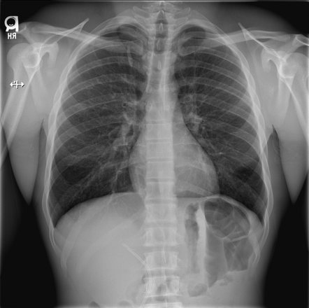 Partially Calcified Orphaned VP Shunt Radiology Case Radiopaedia Org