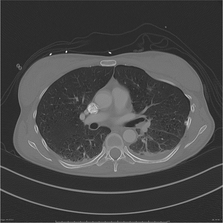 Rib Fractures Radiology Reference Article Radiopaedia Org