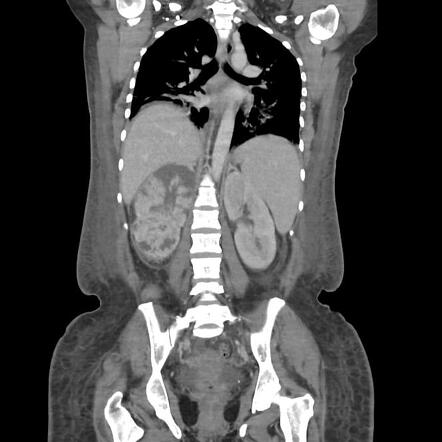 Acute Pyelonephritis Radiology Case Radiopaedia Org