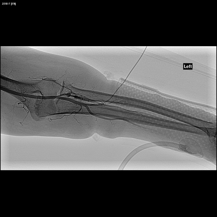 Normal Forearm Angiogram Radiology Case Radiopaedia Org