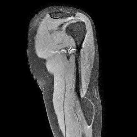 Intramuscular Lipoma Radiology Case Radiopaedia Org