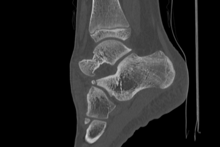 Anterior Calcaneal Process Fracture Radiology Case Radiopaedia Org