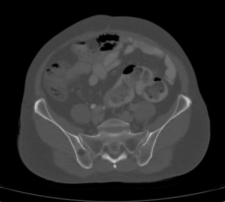 Intraosseous Lipoma Image Radiopaedia Org