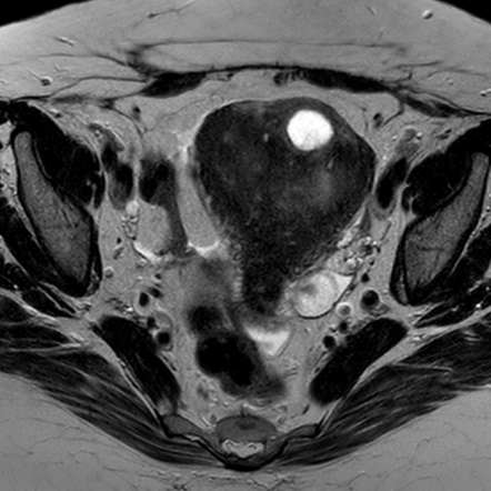 Uterine Cystic Adenomyosis Radiology Case Radiopaedia Org