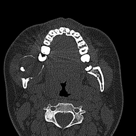 Keratocystic Odontic Tumor Image Radiopaedia Org