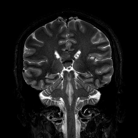 Pericallosal Lipoma Image Radiopaedia Org