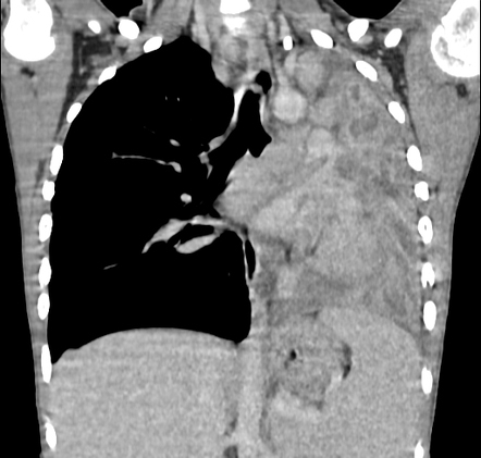 Inflammatory Myofibroblastic Tumor Of The Lung Radiology Case