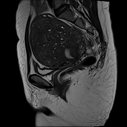 Diffuse Uterine Adenomyosis Radiology Case Radiopaedia Org