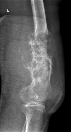 Osteosarcoma Pathological Fracture Radiology Case Radiopaedia Org