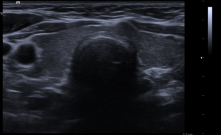 Toxic Thyroid Adenoma Radiology Case Radiopaedia Org