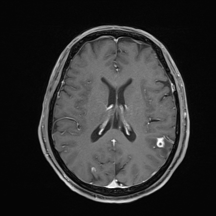 Neurocysticercosis Radiology Case Radiopaedia Org