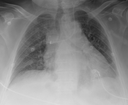 Central Venous Catheter With Azygous Vein Termination Radiology Case