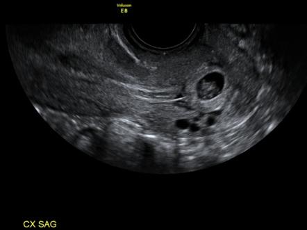 Cervical Ectopic Pregnancy Radiology Reference Article Radiopaedia Org