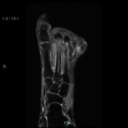 Freiberg Disease Radiology Reference Article Radiopaedia Org