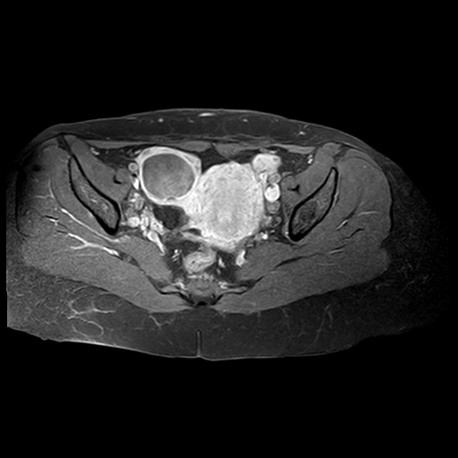 Ovarian Serous Cystadenoma Image Radiopaedia Org