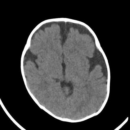 Benign Enlargement Of The Subarachnoid Space In Infancy Radiology