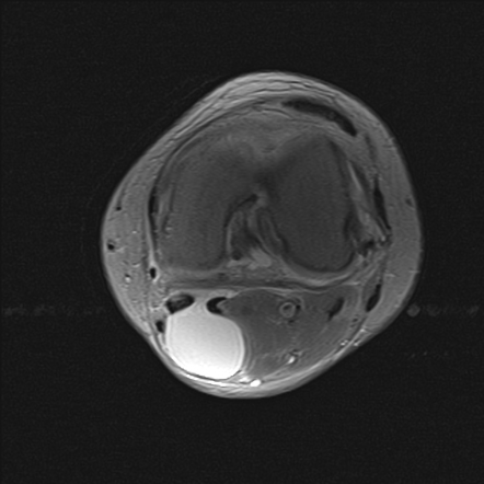 Baker Cyst Radiology Case Radiopaedia Org