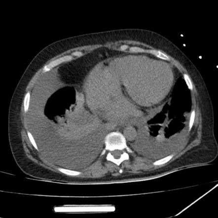 Pleural Effusion Radiology Reference Article Radiopaedia Org