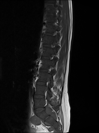 Extramedullary Hematopoiesis Radiology Case Radiopaedia Org