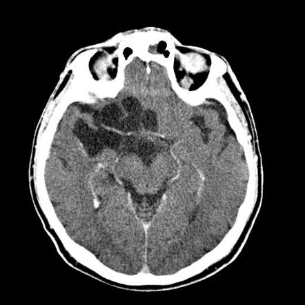 Intracranial Epidermoid Cyst Image Radiopaedia Org