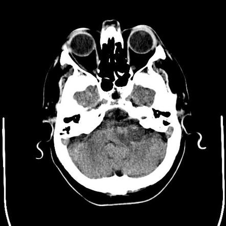 Acoustic Schwannoma Cystic Image Radiopaedia Org