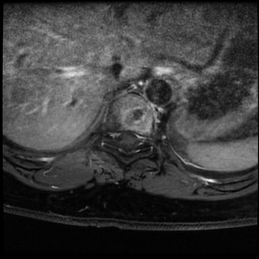 Schmorl Node Acute Image Radiopaedia Org