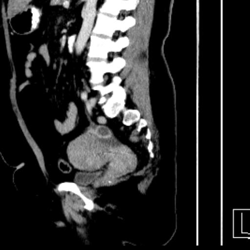 Corpus Luteum Cyst Image Radiopaedia Org