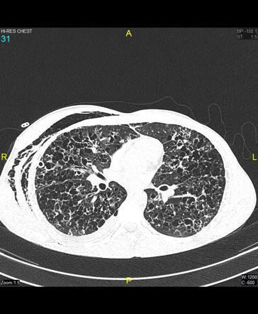 Pulmonary Langerhans Cell Histiocytosis Image Radiopaedia Org