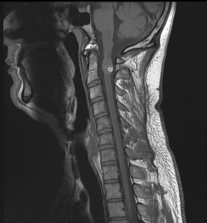 Spinal Cord Cavernous Malformation Radiology Reference Article