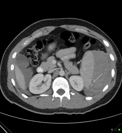 Spontaneous Atraumatic Splenic Rupture Image Radiopaedia Org