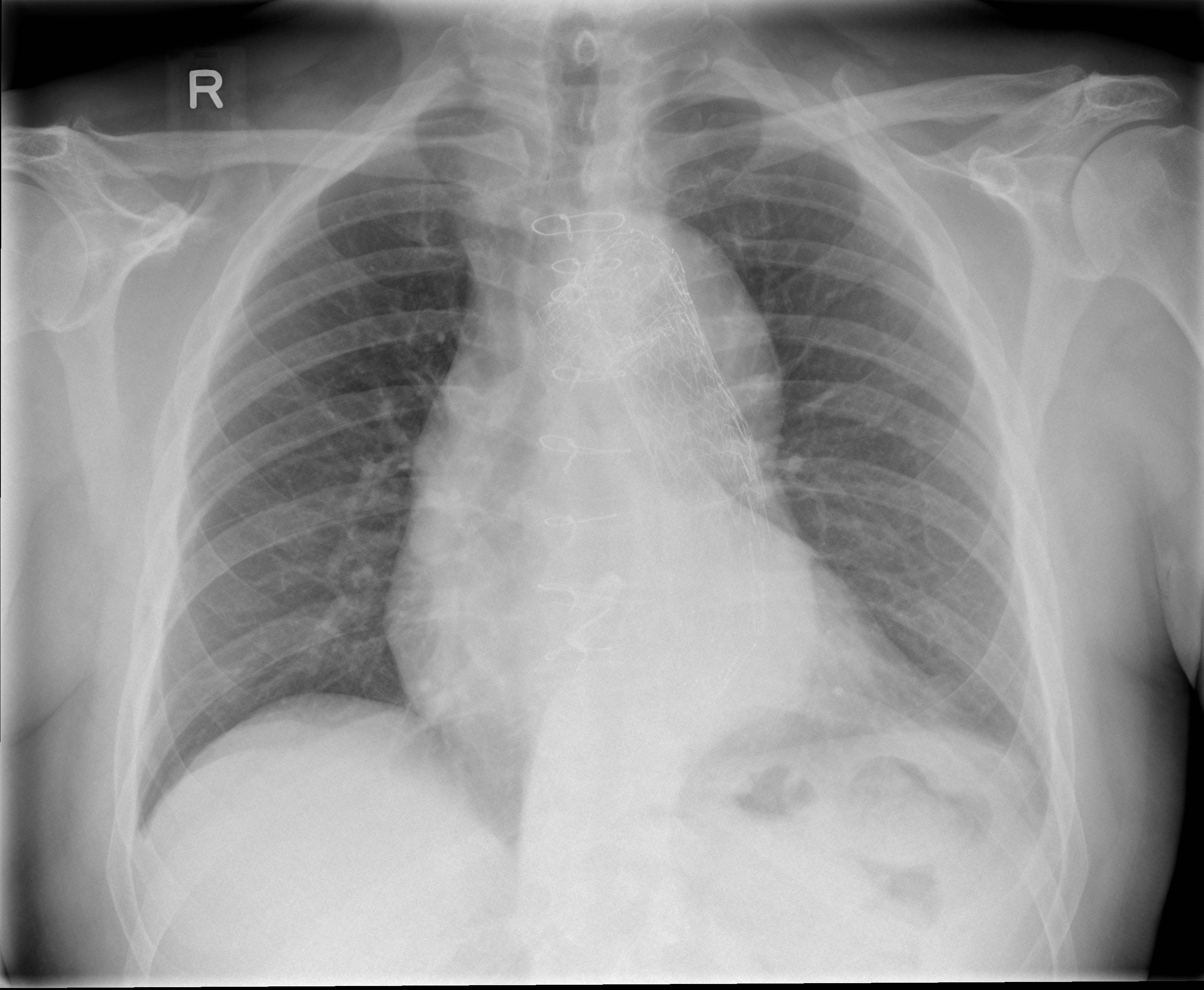 Aortic Dissection See Full Sequence With Displaced Ca Vrogue Co