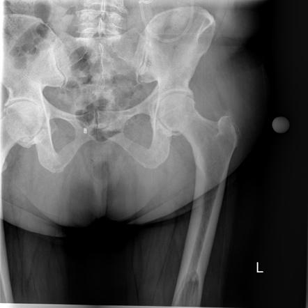 Paget Disease With Blade Of Grass Sign Radiology Case Radiopaedia Org