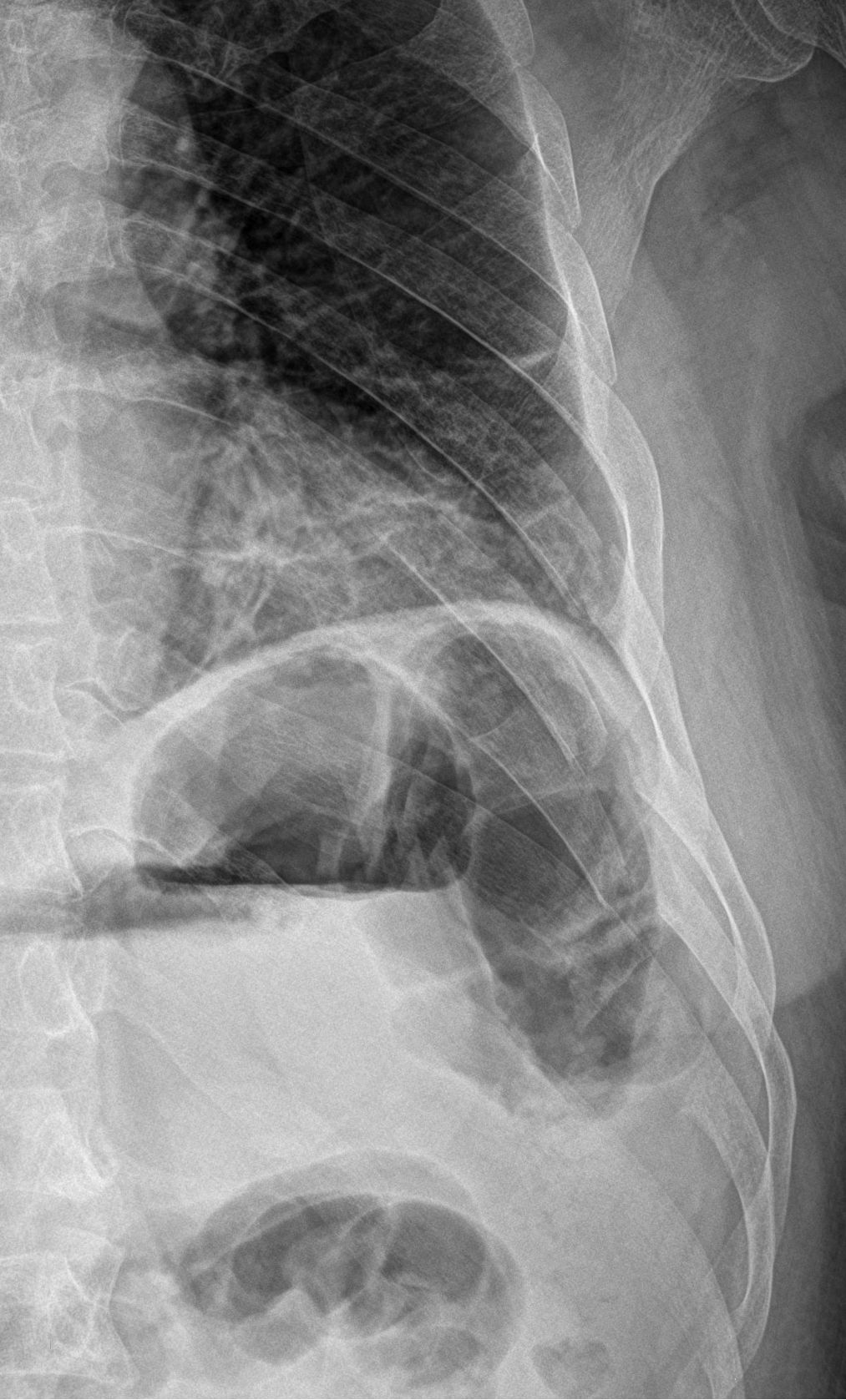 Rib Fractures Image Radiopaedia Org