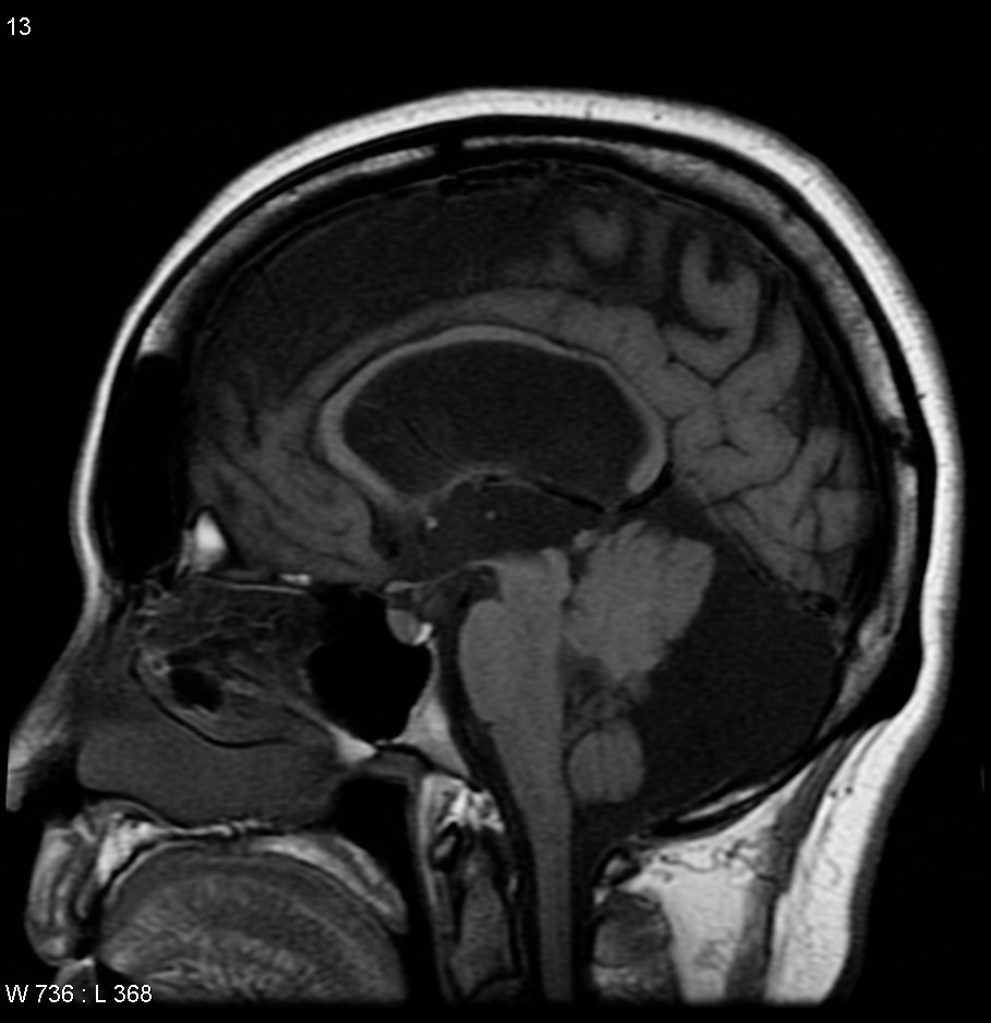 Posterior Fossa Arachnoid Cyst Mri Sexiz Pix