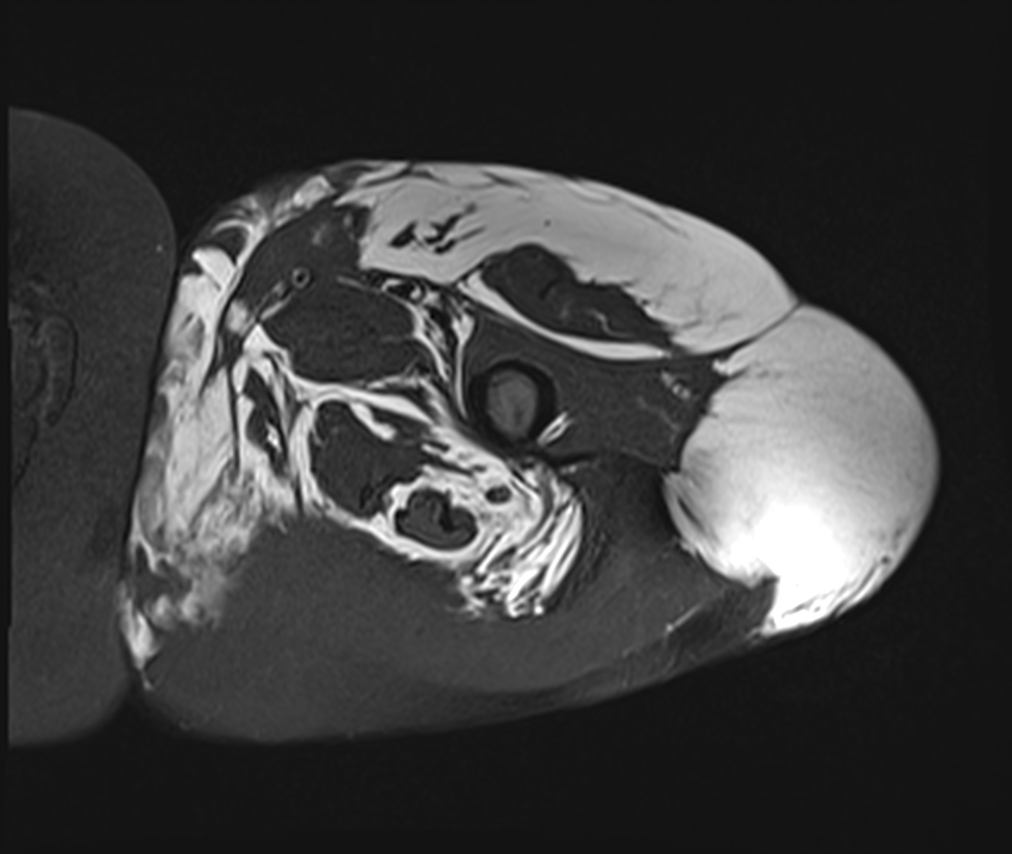 Myxoid Liposarcoma Extensive Image Radiopaedia Org