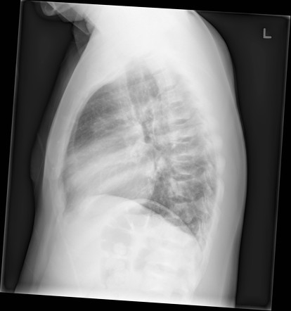 Sickle Cell Disease Skeletal Manifestations Radiology Reference