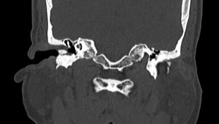 Exostosis Of The External Auditory Canal Surfer S Ear Image