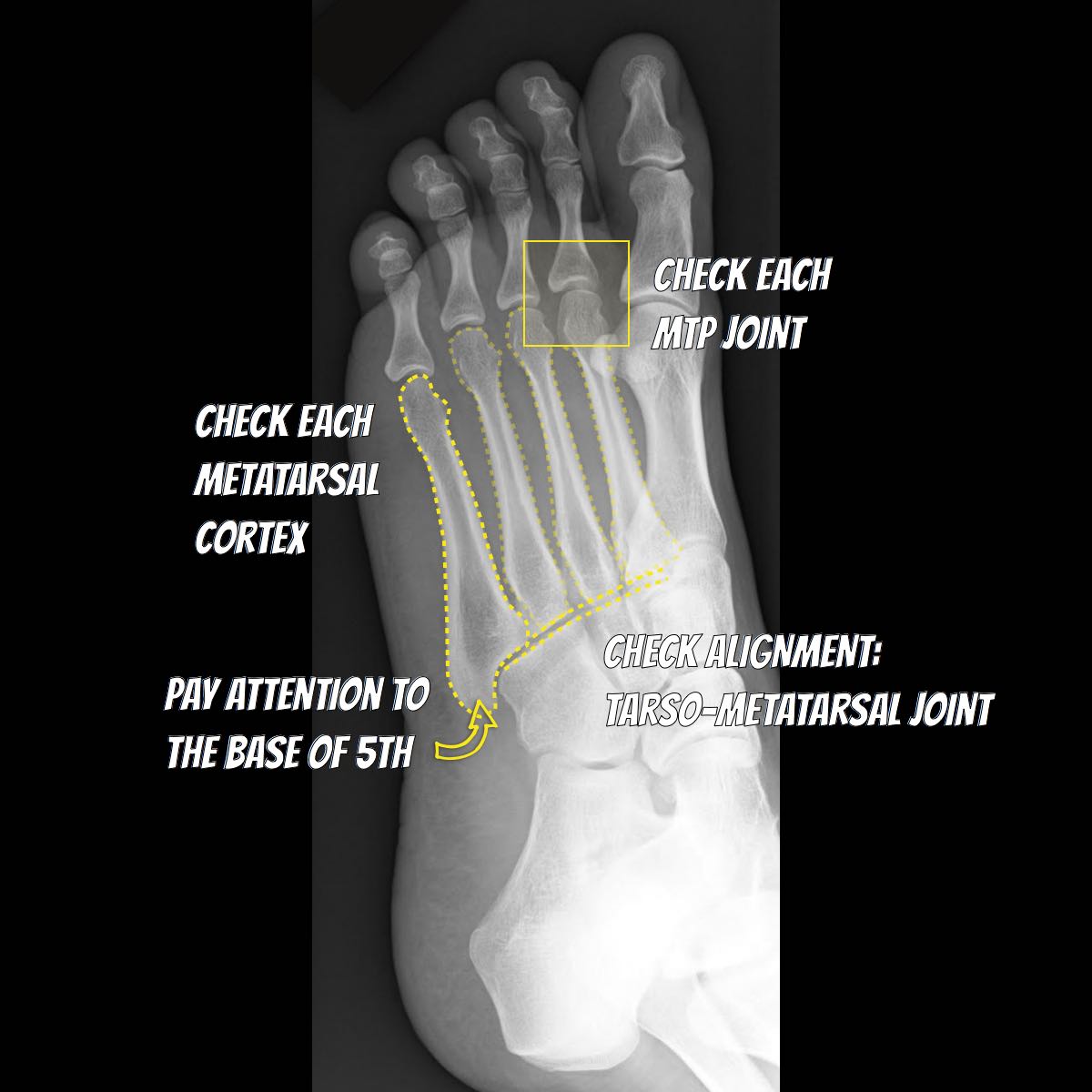 Foot Annotated X Ray Image Radiopaedia Org