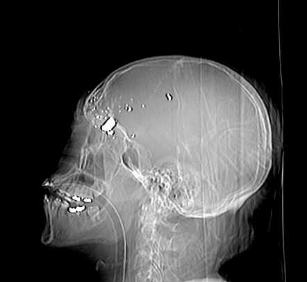 Imaging Of Gunshot Injuries Radiology Reference Article Radiopaedia Org