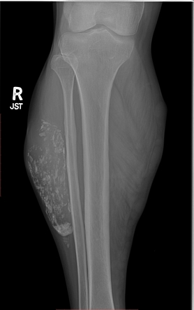 Calcific Myonecrosis Radiology Case Radiopaedia Org