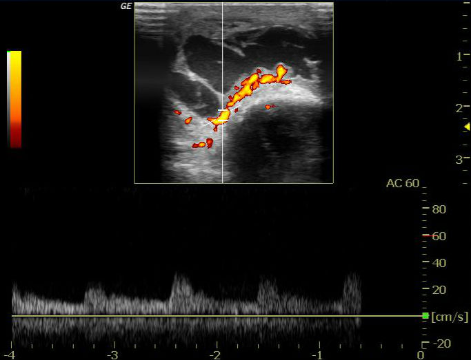 Olecranon Bursitis Image Radiopaedia Org