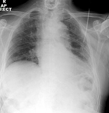 Viewing Playlist Fy Nasogastric Tube Placement Radiopaedia Org