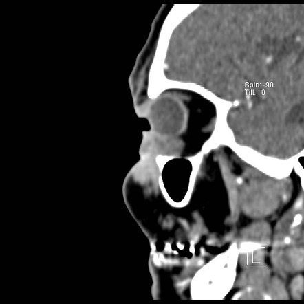 Basal Cell Carcinoma Radiology Reference Article Radiopaedia Org